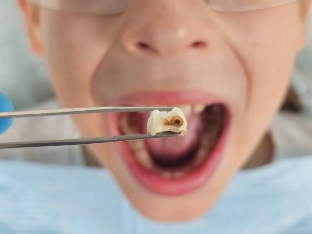 Best Emergency Wisdom Teeth Removal in Clay City, IN